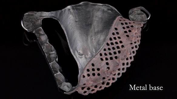 Upper metal base partial denture/occlusal stabilisation splint/obturator - full protocol