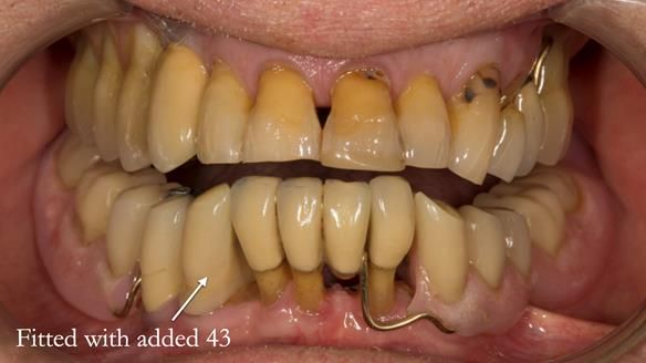 Ken – going downhill, first class