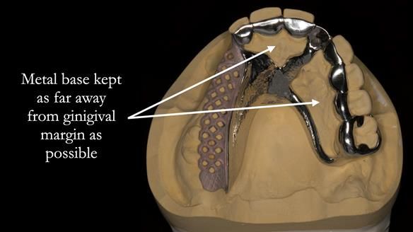 Newsletter 51 Managing Anne’s failing dentition with distal extension base RPD/Splint FULL PROTOCOL