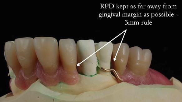 Finlay's Newsletter 59 Ultra hard partial dentures made for Gill