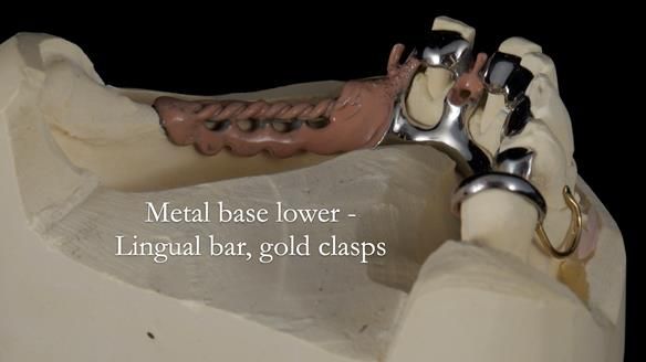 Newsletter 55 Provision of metal based partial dentures for Zephyrine with a repaired cleft lip and palate