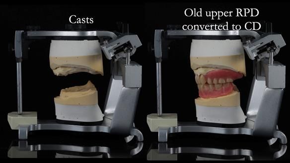 Finlay's Newsletter 62 provision of extractions and metal based complete dentures for Rafique