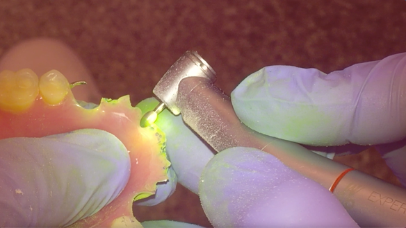 Figure 35 Occlusion adjusted on the collets. Natural teeth to occlude in ICP in the same way with and without the denture.