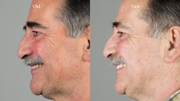 Newsletter 78: What do Clark Gable and a Locator® overdenture have in common?