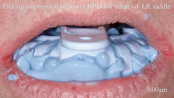 Newsletter 52 Managing Jo’s failing dentition with extractions and Mk 1/Mk 2 complete upper dentures and lower partial dentures FULL PROTOCOL