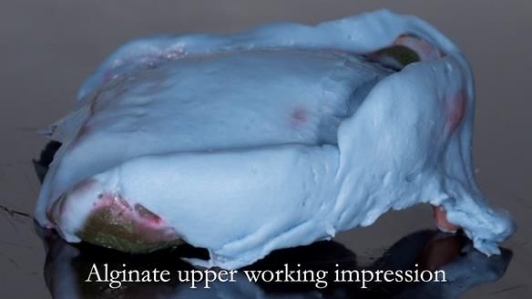 Managing poor implant positioning with complete dentures and Locator attachments - full protocol Newsletter 41