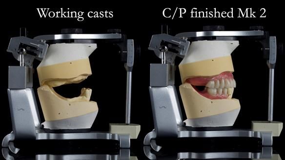 Newsletter 52 Managing Jo’s failing dentition with extractions and Mk 1/Mk 2 complete upper dentures and lower partial dentures FULL PROTOCOL