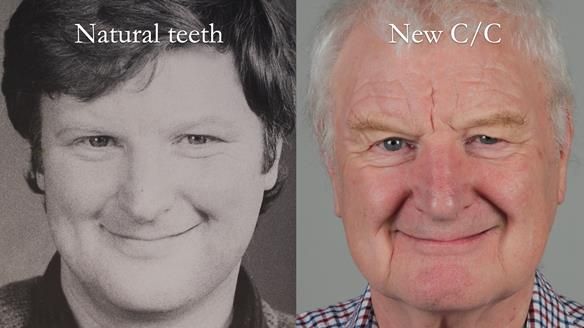 Newsletter 57 showcases the making and fitting process of implant-supported complete dentures for Alisdair