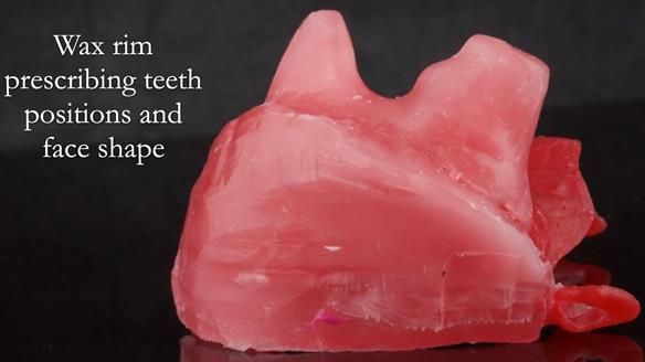 Upper metal base partial denture/occlusal stabilisation splint/obturator - full protocol