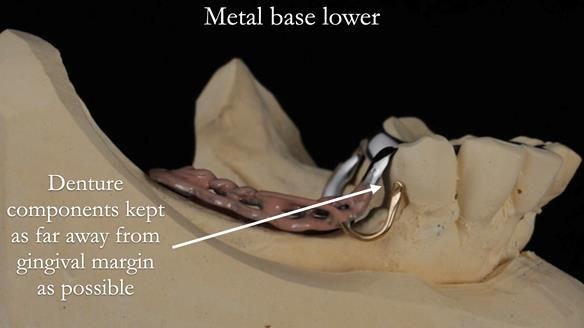 Newsletter 54 case presentation upper complete denture and lower Scandinavian designed hygienic partial denture for David