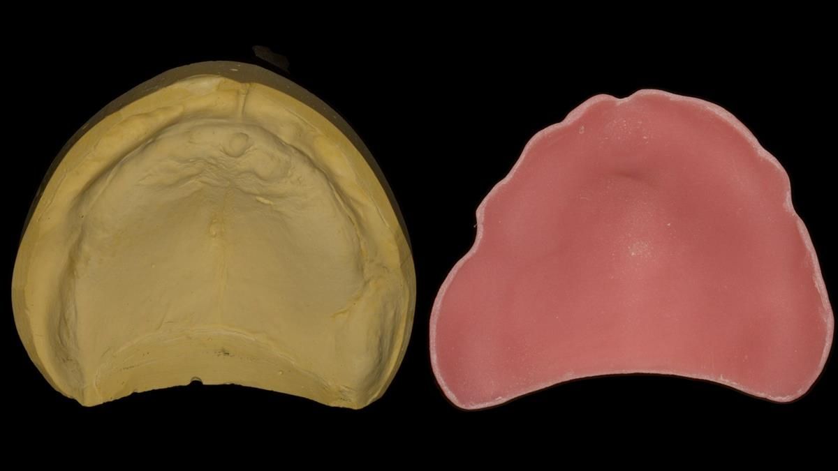 Newsletter 87 – Father Peter: A Partial Denture that needed Minor Miracle