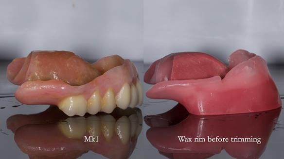 Newsletter 77: Jeremy’s case – immediate complete upper denture