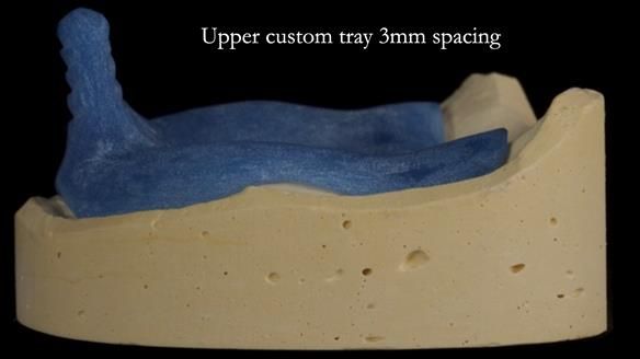 Newsletter 83: Sheila’s Complete Denture Success