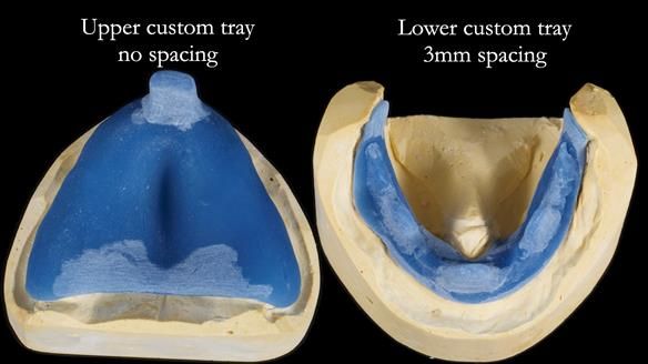 Newsletter 80 - Gordon’s dentures: the one case in 1,000 where my technique failed