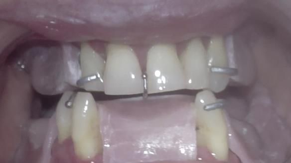 Finlay's Case Study Newsletter 40 - Immediate Mk 1 RPD to Definitive Mk 2 RPD - full protocol