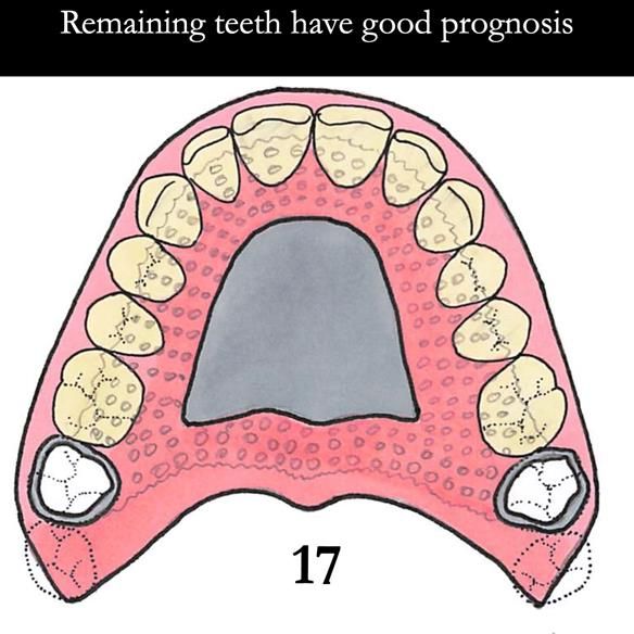 Universal Scandinavian partial denture designs