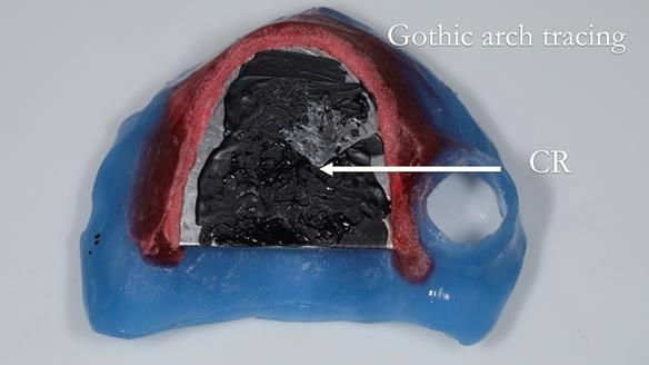 Finlay's Newsletter 58 Gasket upper partial denture for Zoe