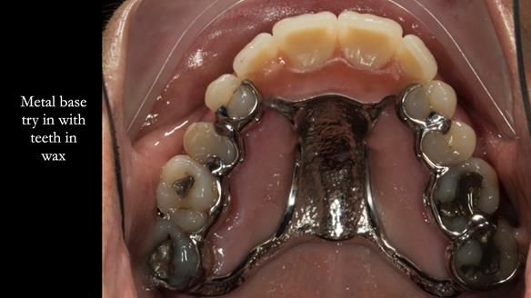 Finlay's Newsletter 63 Case study provision of metal based Scandinavian RPD - functional 10 years on