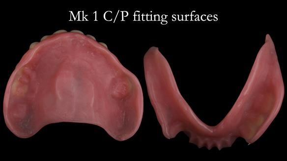 Newsletter 52 Managing Jo’s failing dentition with extractions and Mk 1/Mk 2 complete upper dentures and lower partial dentures FULL PROTOCOL
