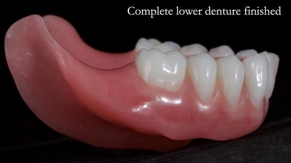 Newsletter 65 Marisa Provision of Complete Dentures on badly placed implants