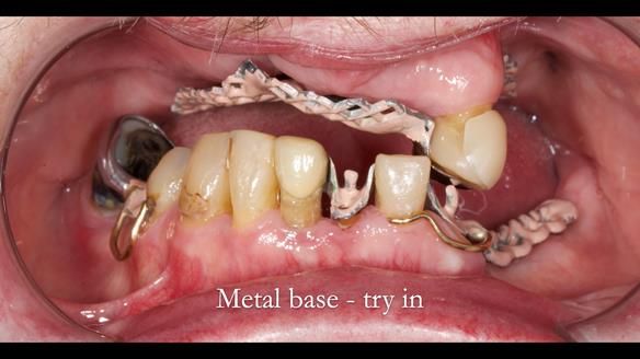 Newsletter 55 Provision of metal based partial dentures for Zephyrine with a repaired cleft lip and palate