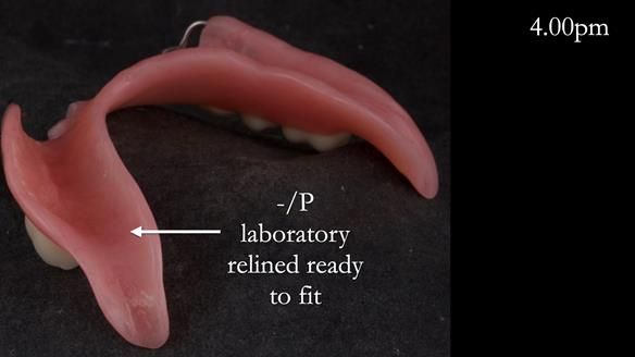 Newsletter 52 Managing Jo’s failing dentition with extractions and Mk 1/Mk 2 complete upper dentures and lower partial dentures FULL PROTOCOL