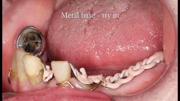 Newsletter 55 Provision of metal based partial dentures for Zephyrine with a repaired cleft lip and palate