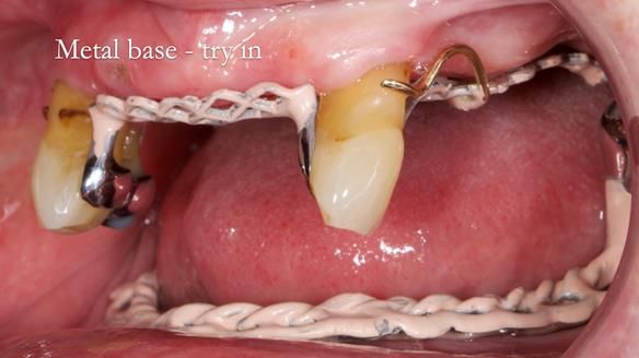 Finlay's Newsletter 59 Ultra hard partial dentures made for Gill