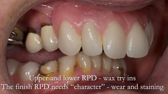 Eileen's transformation with upper and lower RPDs of Scandinavian hygienic design FULL PROTOCOL