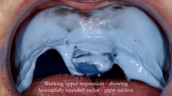 Newsletter 83: Sheila’s Complete Denture Success