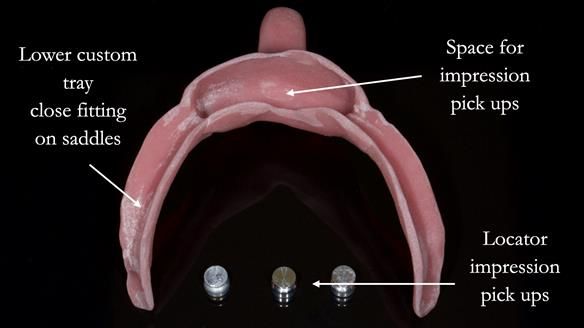 Lower custom tray with Locator impression pick ups