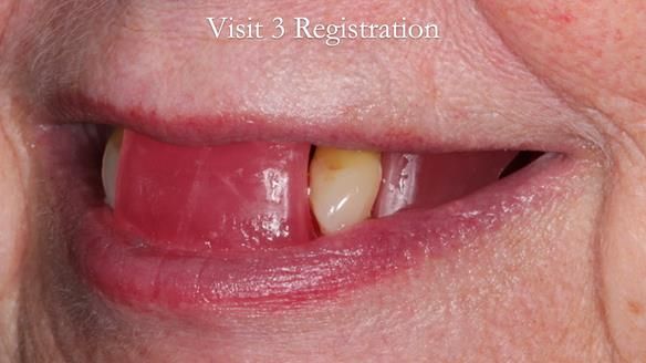 Finlay's Newsletter 59 Ultra hard partial dentures made for Gill