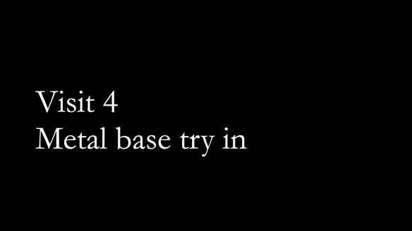 Newsletter 51 Managing Anne’s failing dentition with distal extension base RPD/Splint FULL PROTOCOL