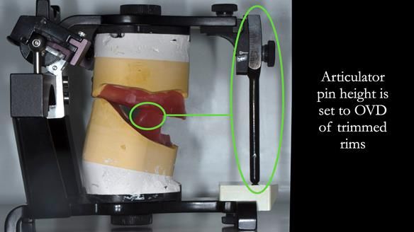 The correctly trimmed rims are used to set the vertical dimension of the patient during visit 3. The working casts which had been articulated after visit 2 with the primary rims are used for this.