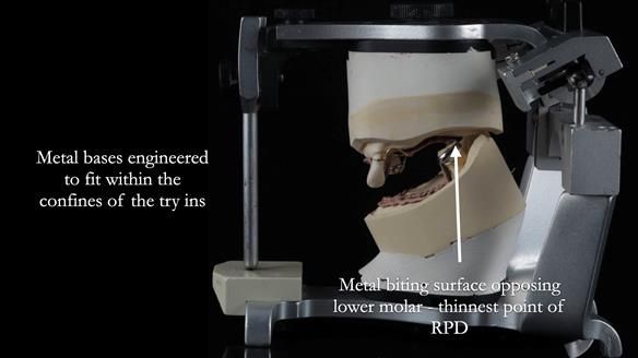Finlay's Newsletter 59 Ultra hard partial dentures made for Gill