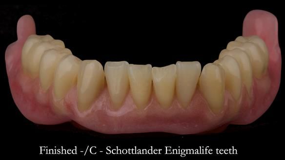 Complete denture Class II div 2 deep overbite Newsletter 39