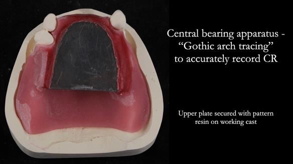 Finlay's Newsletter 59 Ultra hard partial dentures made for Gill