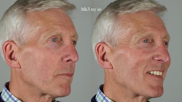 Newsletter 77: Jeremy’s case – immediate complete upper denture