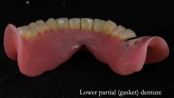Newsletter 82 Mary - A complete upper and a one-tooth gasket denture