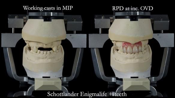Newsletter 81 - Pam’s Story — how a partial denture changed her life (+ live walkthrough this Thursday)