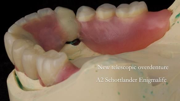 Newsletter 76: Jackie’s case – Telescopic overdenture & precision RPD (the tricky truth!)
