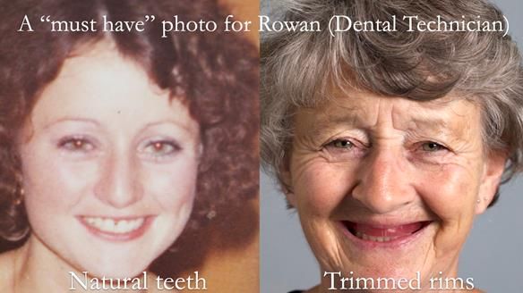 Solving Linda’s Failed “All on 4” implant bridges - full protocol Newsletter 42