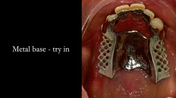 Finlay's Case Study Newsletter 40 - Immediate Mk 1 RPD to Definitive Mk 2 RPD - full protocol