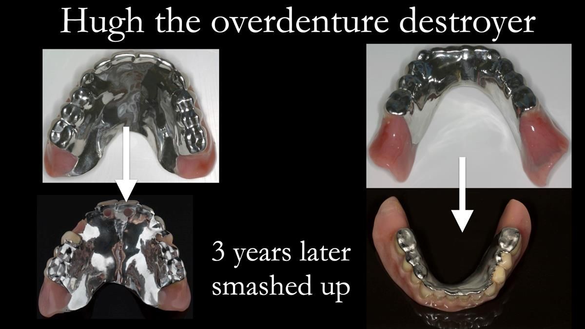 Newsletter 87 – Father Peter: A Partial Denture that needed Minor Miracle
