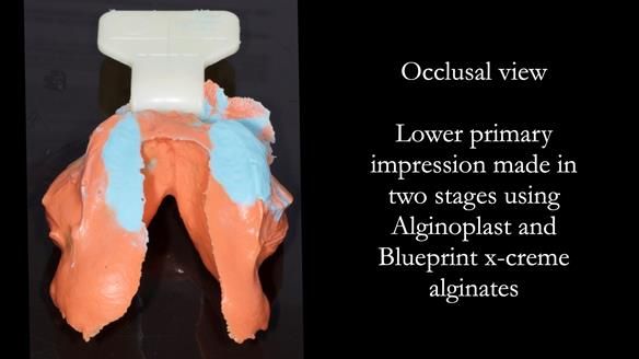 Replacing Madeline’s Complete denture FULL PROTOCOL