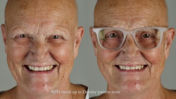 Newsletter 81 - Pam’s Story — how a partial denture changed her life (+ live walkthrough this Thursday)