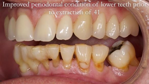 Newsletter 54 case presentation upper complete denture and lower Scandinavian designed hygienic partial denture for David
