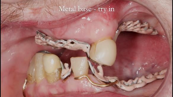 Newsletter 55 Provision of metal based partial dentures for Zephyrine with a repaired cleft lip and palate