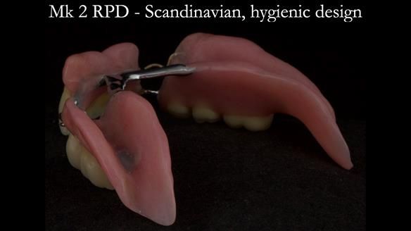 Finlay's Case Study Newsletter 40 - Immediate Mk 1 RPD to Definitive Mk 2 RPD - full protocol