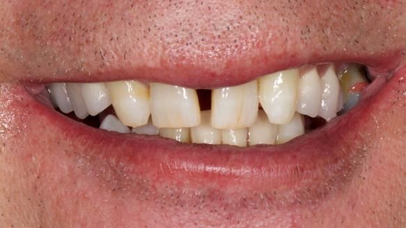Newsletter 86 Peter the Architect — precision removable partial dentures case study
